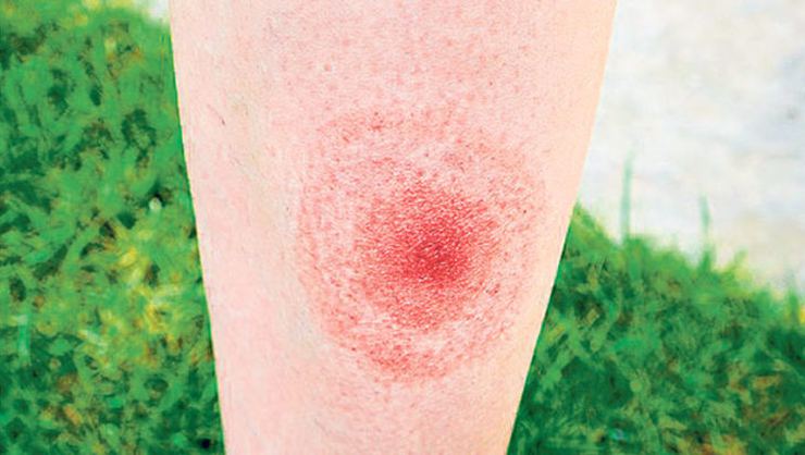 Lyme hastalığı nedir? Uzmanlar uyarıyor: Çağın salgını
