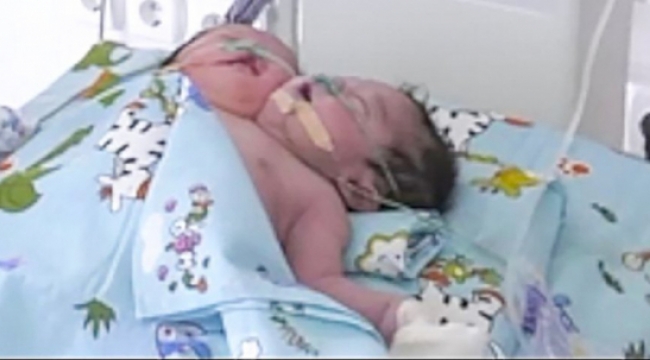 Çift başlı bebek muamması: İki beden tek vücutta gelişti